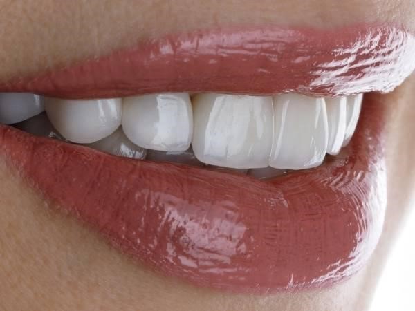 Porcelain Laminate Veneers in Turkey - DMAX Health